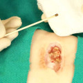 How to Recognize What Dissolvable Stitches Look Like When Combined With Silver Nitrate Therapy