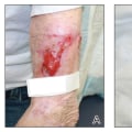 Boosting Surgical Incision Wound Healing Stages With Silver Nitrate Treatment