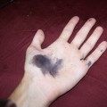 The Hidden Dangers of Silver Nitrate on Skin