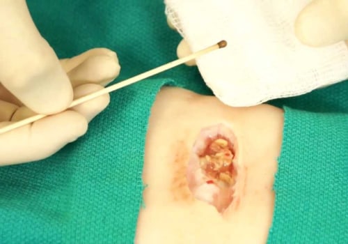 How to Recognize What Dissolvable Stitches Look Like When Combined With Silver Nitrate Therapy