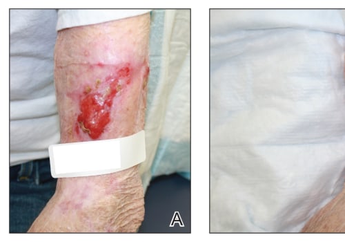 Boosting Surgical Incision Wound Healing Stages With Silver Nitrate Treatment