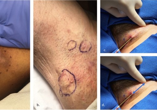 Exploring Effective Treatments For Types Of Skin Tunneling Wounds With Silver Nitrate