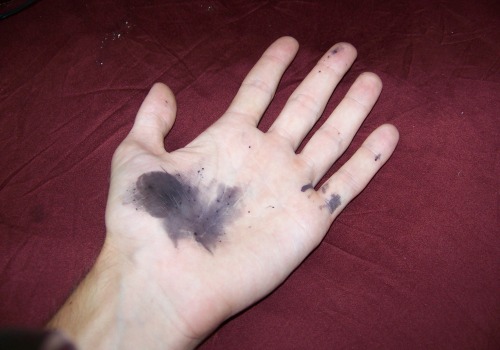 The Hidden Dangers of Silver Nitrate on Skin